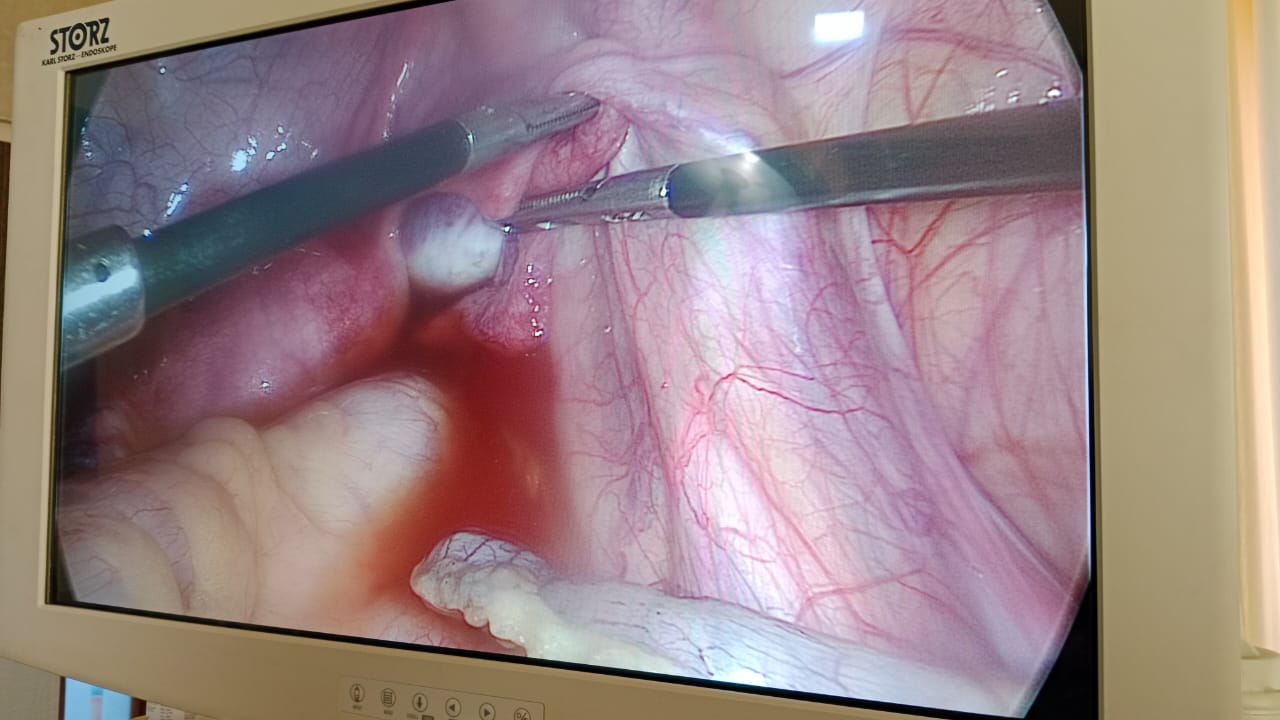 laparoscopic appendectomy in surat