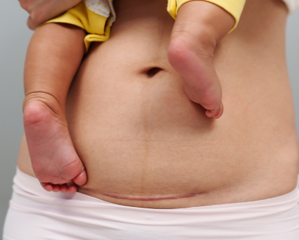 Cesarean Delivery (C-Section)